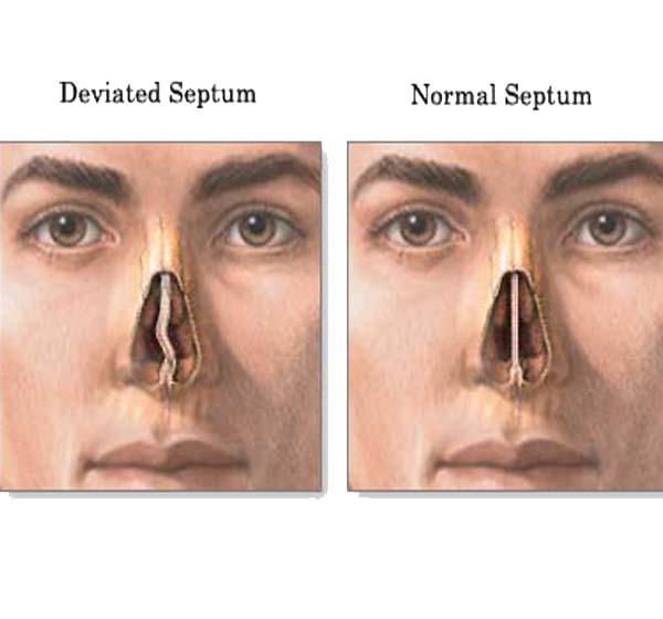deviated septum diagram before after